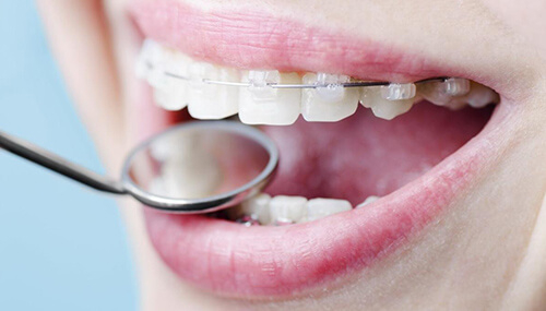 Керамічні брекети: вирівнюємо зуби ефективно