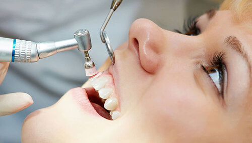 Методи зняття зубних відкладень