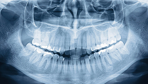 Навіщо робити рентген зубів?