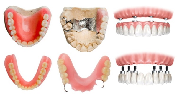 Види і методи протезування зубів